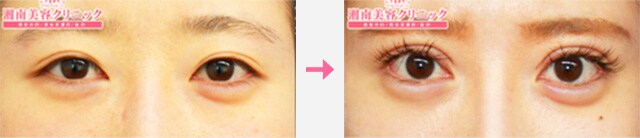 眼瞼下垂_症例写真01