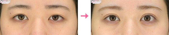 眼瞼下垂_症例写真03