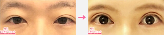 眼瞼下垂_症例写真04