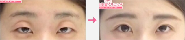 眼瞼下垂_症例写真05