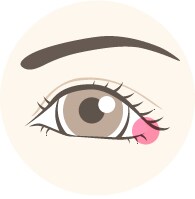 下眼瞼下制法（たれ目術）