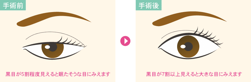 切らない眼瞼下垂プレミアム 二重 目元整形なら湘南美容クリニック 公式 切らない眼瞼下垂プレミアム 二重 目元整形なら湘南美容クリニック 公式