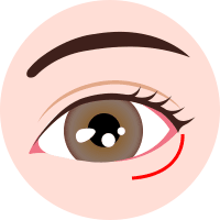下眼瞼下制 (皮膚切開法)step1