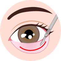 下眼瞼下制 (結膜切開法)step1