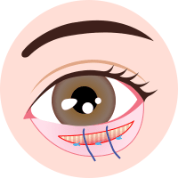 下眼瞼下制 (結膜切開法)step3