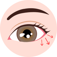 下眼瞼下制 (糸によるタッキング法)step1