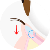 下眼瞼下制 (糸によるタッキング法)step3
