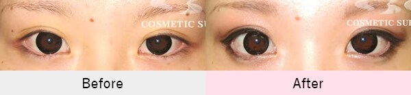 下眼瞼下制法（たれ目術）の症例写真3