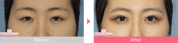 全切開法二重術の症例写真ビフォーアフター