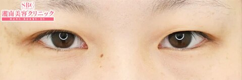 一重に見える末広型二重