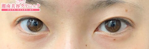 目尻に二重のラインが見えるタイプ