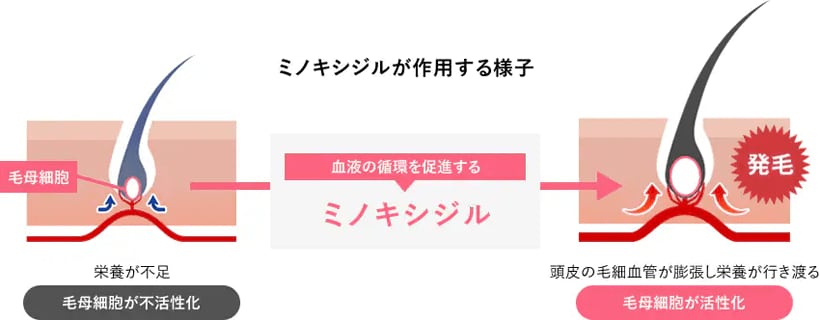 ミノキシジル