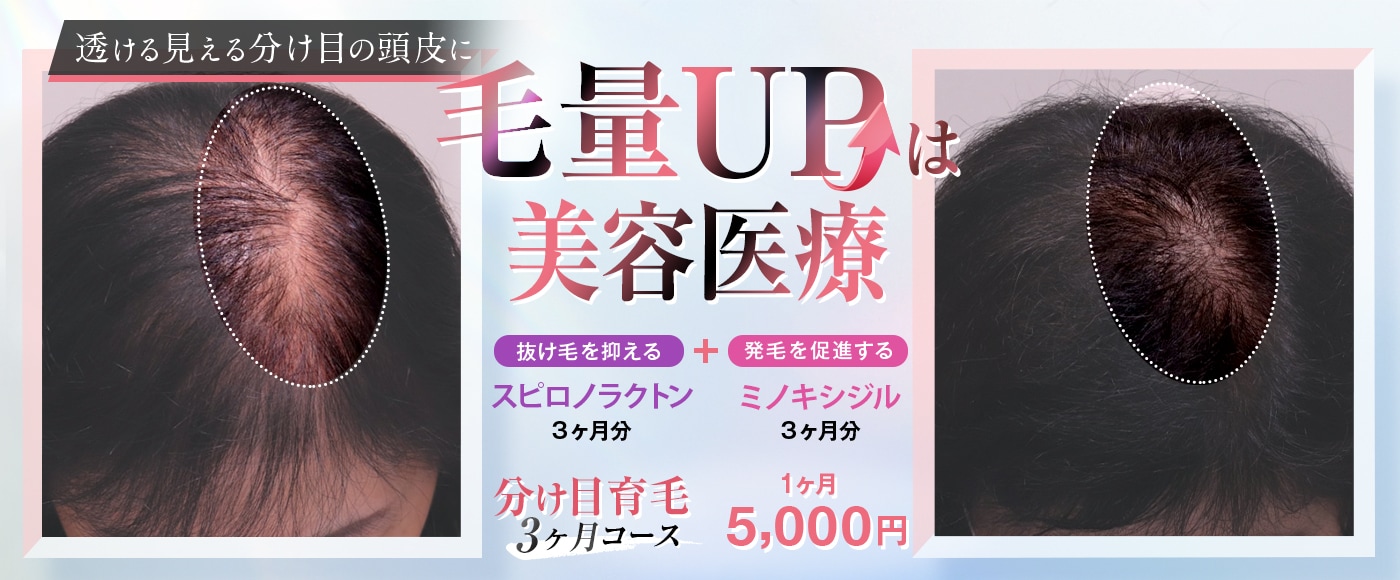 分け目育毛3ヶ月コース