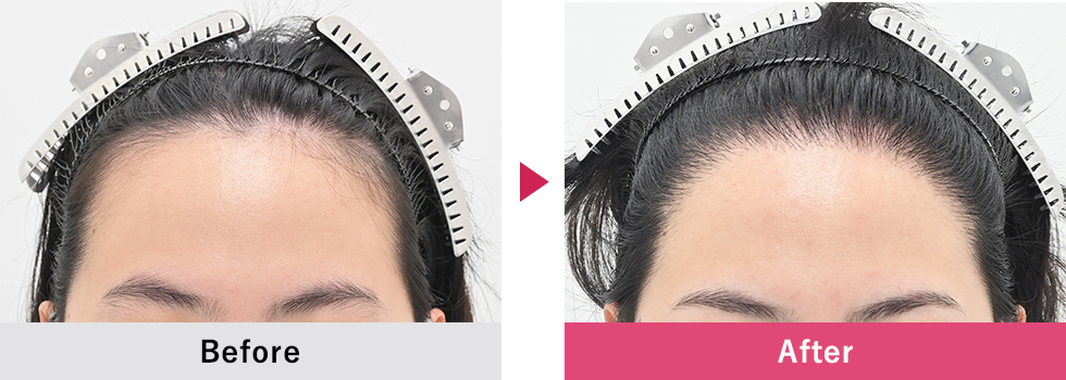 美容植毛 症例１