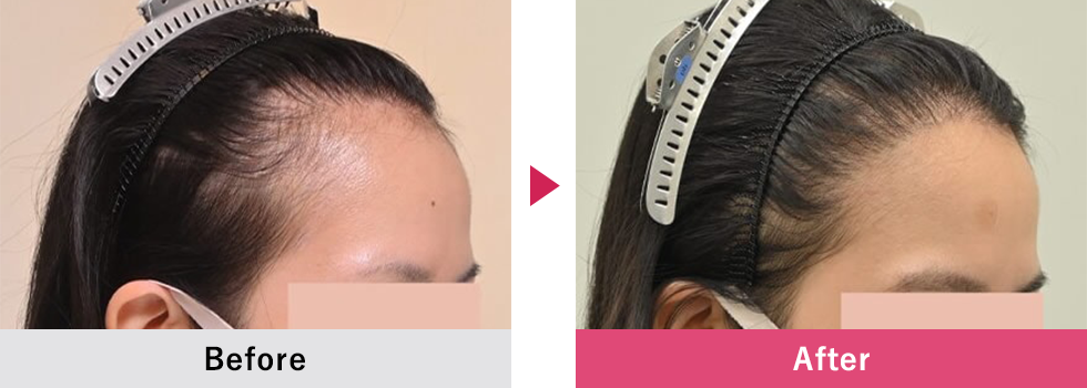 美容植毛 症例2