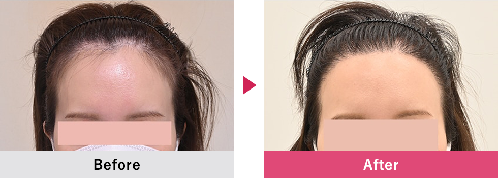美容植毛 症例3