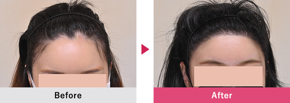 美容植毛 症例4