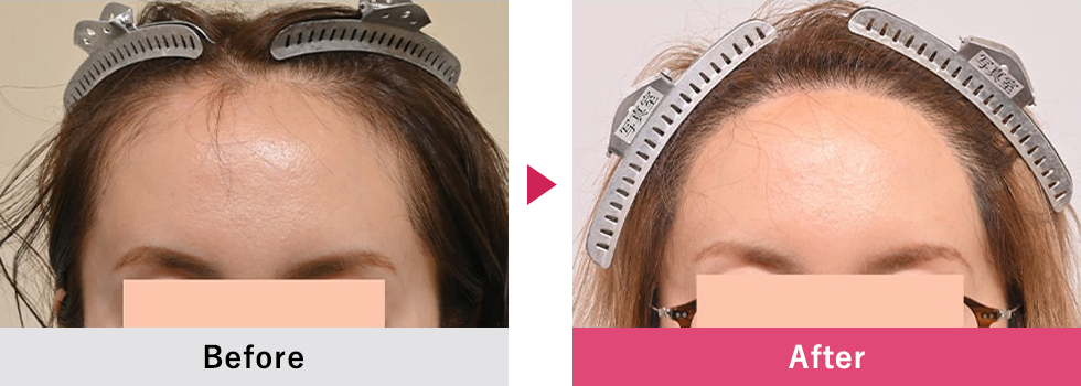 美容植毛 症例5