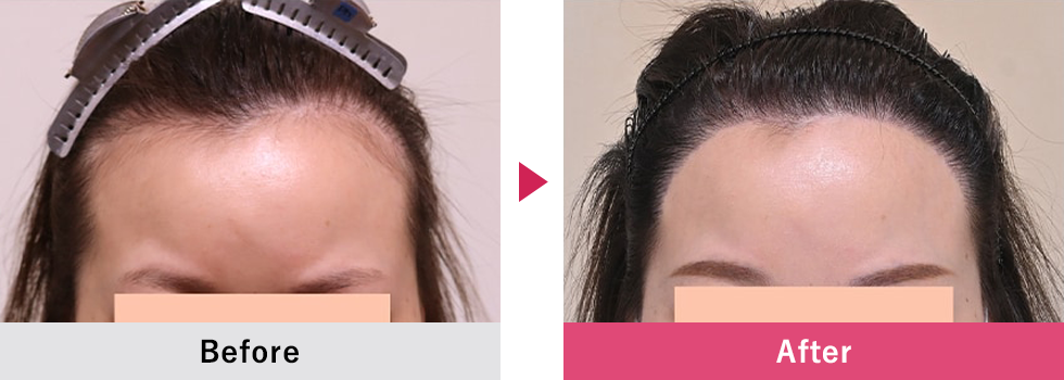 美容植毛 症例6