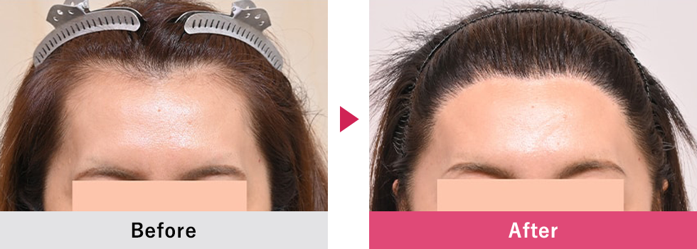 美容植毛 症例7