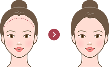 小顔植毛イメージ