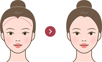 ヘアライン矯正