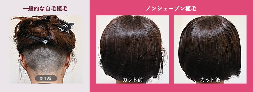 一般的な自毛植毛とノンシェーブン植毛の比較