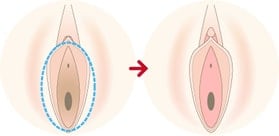 手軽に黒ずみを改善したい