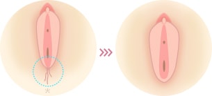 出産で会陰の形が変わってしまった イメージ