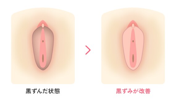 黒ずんだ状態→黒ずみが改善