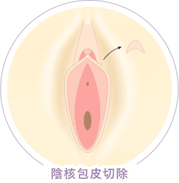 従来法 切除 イメージ