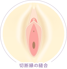 従来法 縫合 イメージ