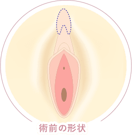 フェミニンリフト デザイン イメージ