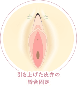 フェミニンリフト 縫合 イメージ