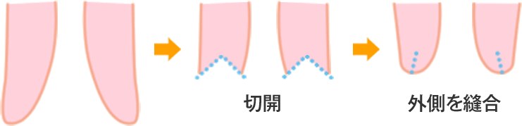 副皮の断面図（副皮除去術）