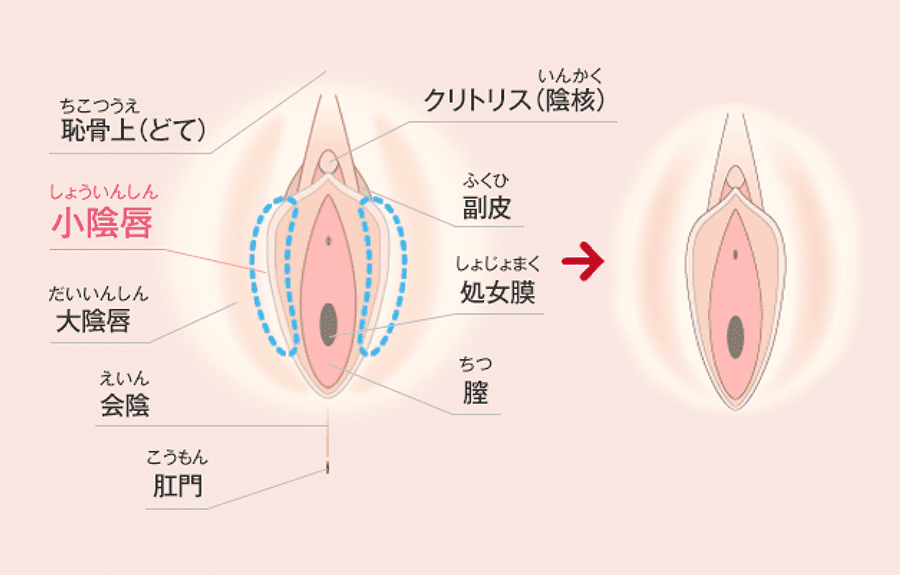 手術 湘南 再生 美容 外科 処女膜