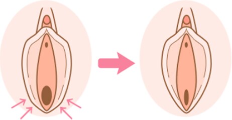 湘南美容区クリニックの膣縮小術（膣壁形成）の特徴