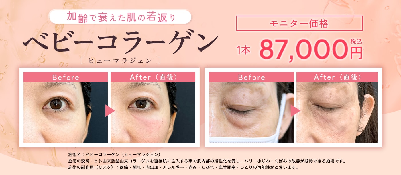 ベビーコラーゲン症例写真