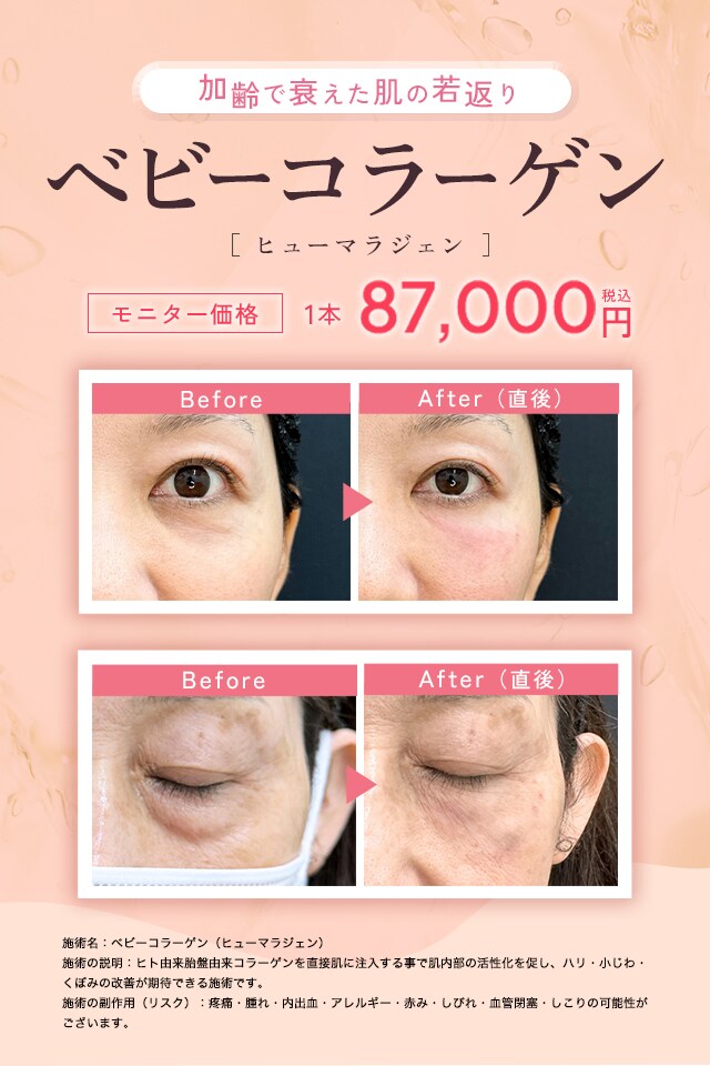 ベビーコラーゲン症例写真