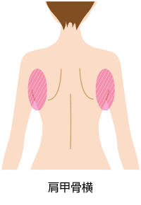脂肪吸引　対象部位　肩甲骨横
