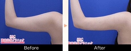 脂肪吸引（二の腕）症例画像