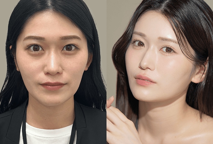 Before After 症例1