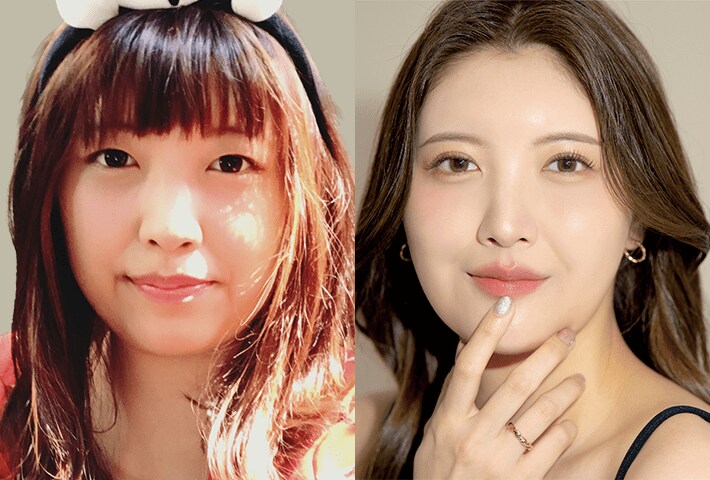 Before After 症例2