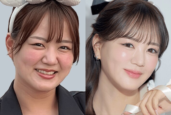 Before After 症例3
