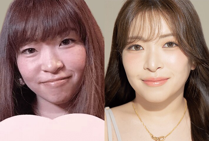Before After 症例4