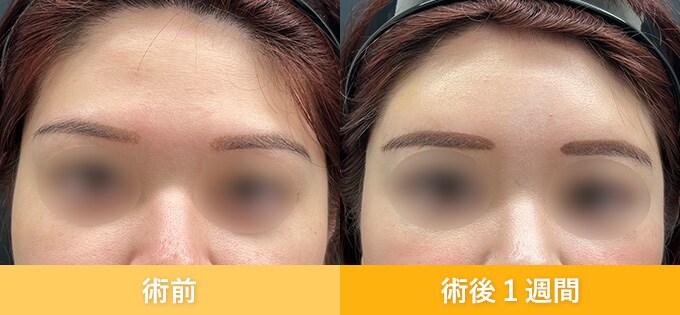 ナチュラル脂肪注射(お顔の脂肪注入)のピックアップ症例写真02