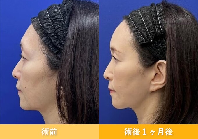 ナチュラル脂肪注射(お顔の脂肪注入)のピックアップ症例写真03