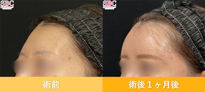 ナチュラル脂肪注射(お顔の脂肪注入)のピックアップ症例写真04