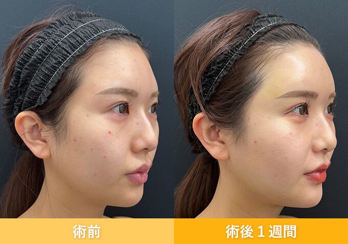 ナチュラル脂肪注射(お顔の脂肪注入)のピックアップ症例写真05