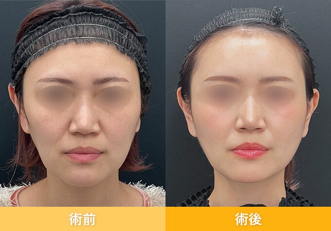 ナチュラル脂肪注射(お顔の脂肪注入)のピックアップ症例写真06